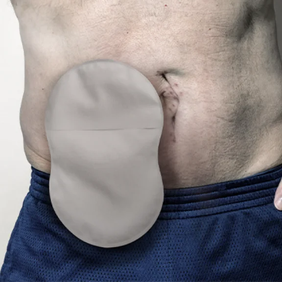 A closeup shot of a man wearing an 8-shaped ostomy pouch with Leak Defense™.