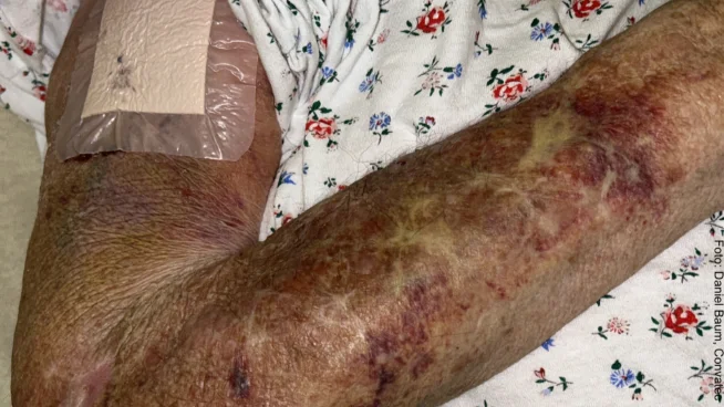 Arm eines Patienten mit Pergamenthaut 