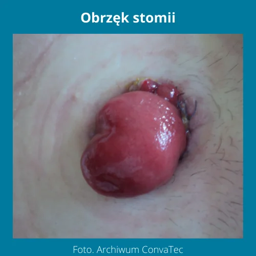 Obrzęk stomii - stomia zdjęcia